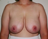 Feel Beautiful - Breast Reduction San Diego 5 - Before Photo